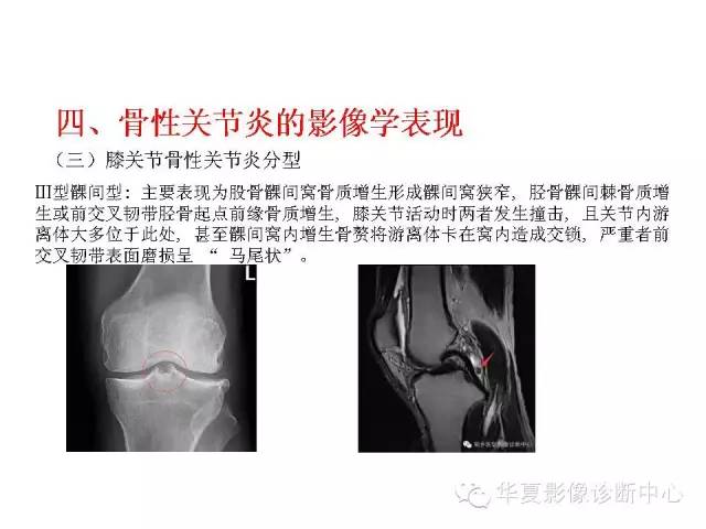 【PPT】深刻理解膝关节骨性关节炎