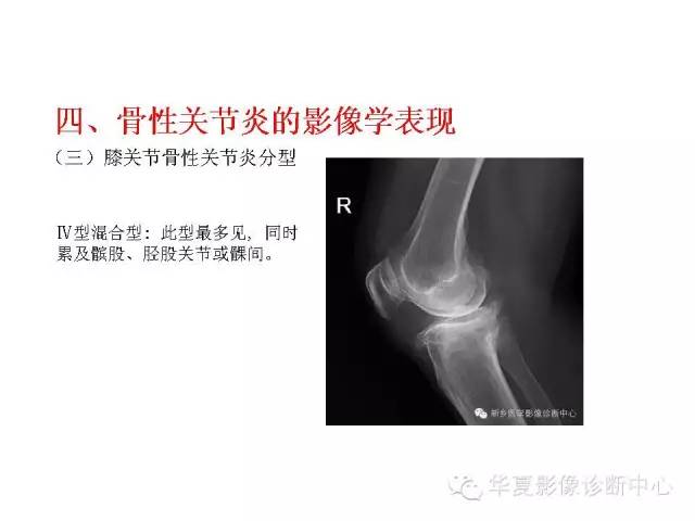 【PPT】深刻理解膝关节骨性关节炎