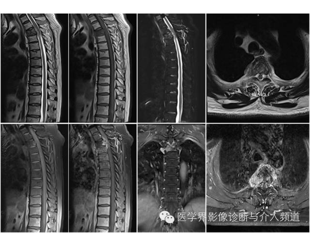 【病例】胸椎去分化软骨肉瘤1例MR影像表现