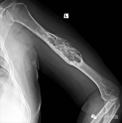 【病例】肱骨浆细胞瘤1例X线影像表现 【病例】肱骨浆细胞瘤1例X线影像表现