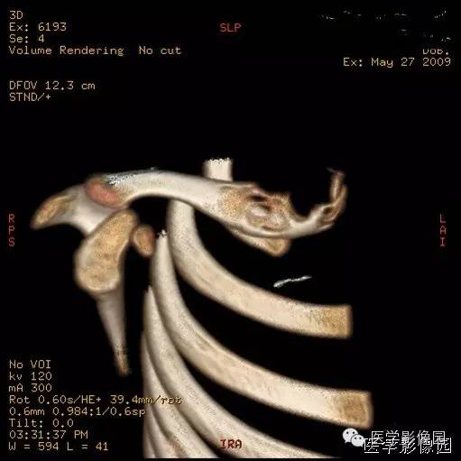 【病例】骨嗜酸性肉芽肿1例CT影像表现 【病例】骨嗜酸性肉芽肿1例CT影像表现