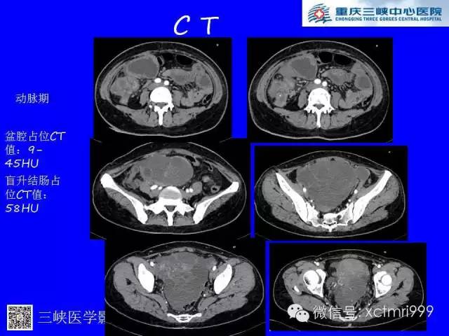 【病例】卵巢粘液性囊腺癌1例CT影像表现