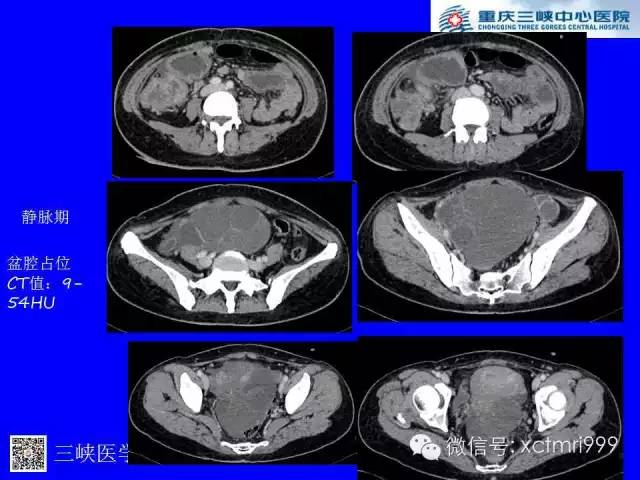 【病例】卵巢粘液性囊腺癌1例CT影像表现