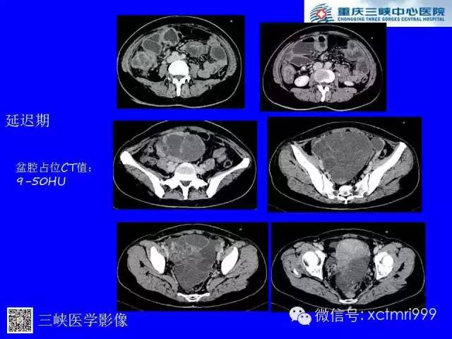 【病例】卵巢粘液性囊腺癌1例CT影像表现