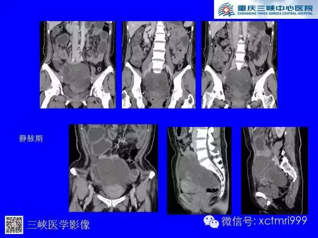 【病例】卵巢粘液性囊腺癌1例CT影像表现
