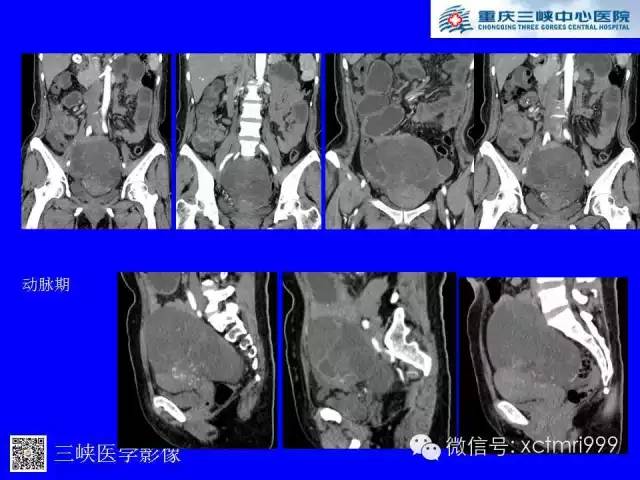 【病例】卵巢粘液性囊腺癌1例CT影像表现