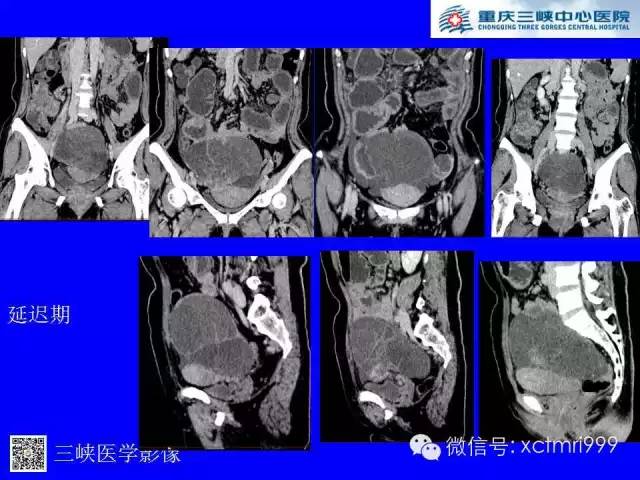 【病例】卵巢粘液性囊腺癌1例CT影像表现