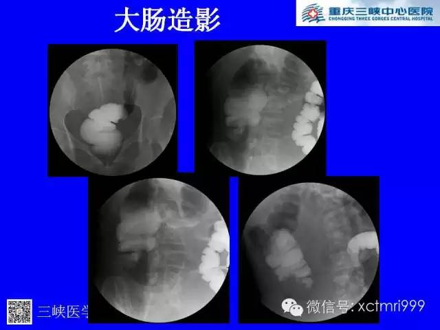 【病例】卵巢粘液性囊腺癌1例CT影像表现