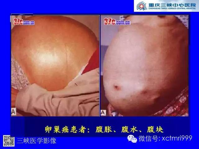 【病例】卵巢粘液性囊腺癌1例CT影像表现