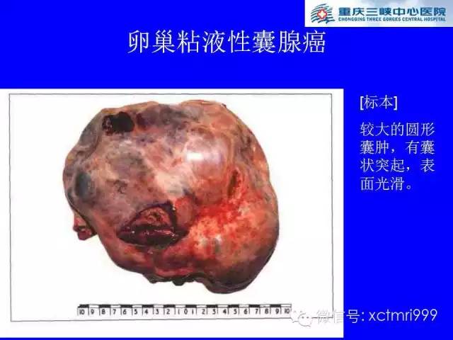 【病例】卵巢粘液性囊腺癌1例CT影像表现