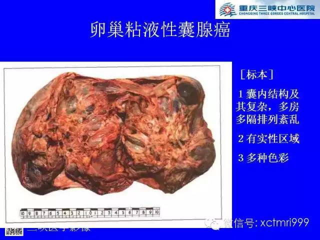 【病例】卵巢粘液性囊腺癌1例CT影像表现
