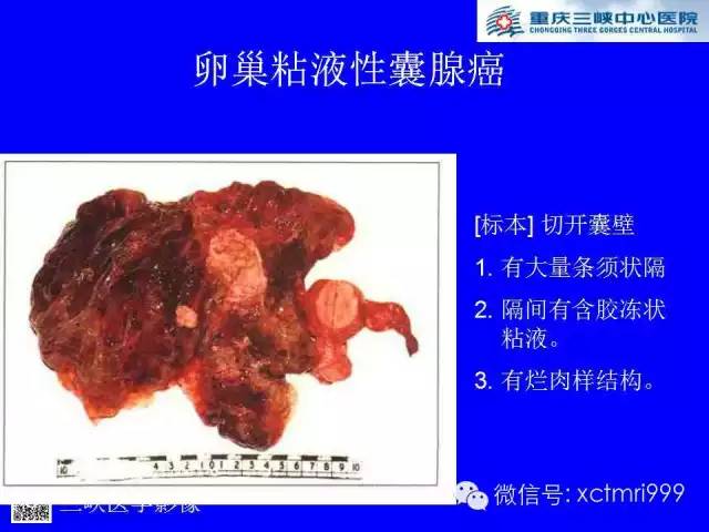 【病例】卵巢粘液性囊腺癌1例CT影像表现