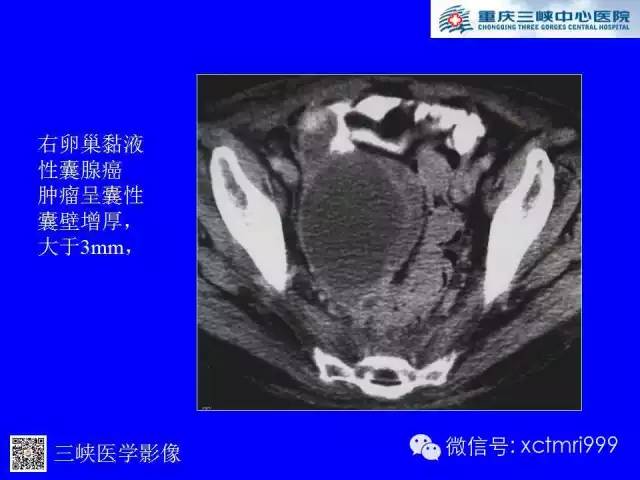 【病例】卵巢粘液性囊腺癌1例CT影像表现