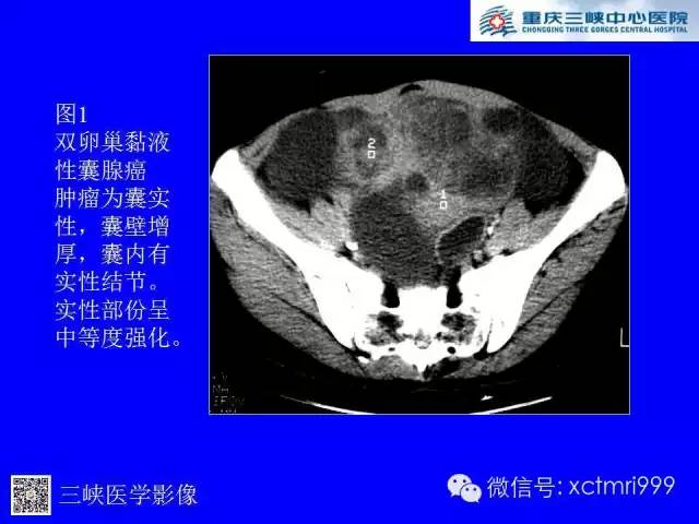 【病例】卵巢粘液性囊腺癌1例CT影像表现