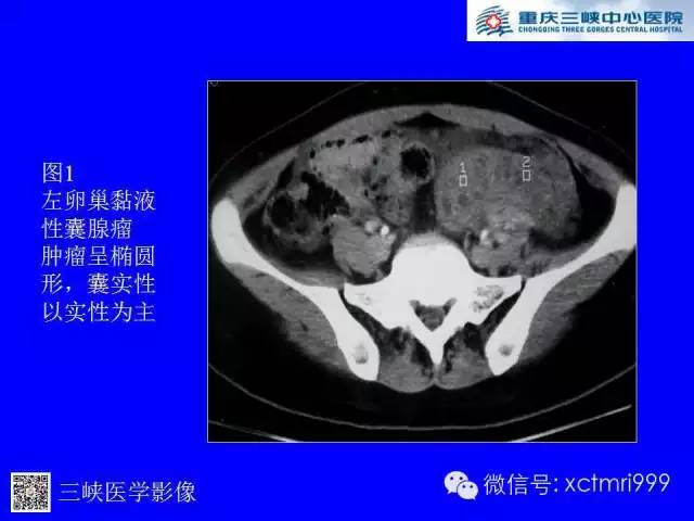 【病例】卵巢粘液性囊腺癌1例CT影像表现