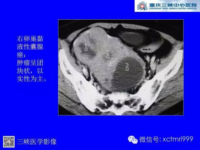 【病例】卵巢粘液性囊腺癌1例CT影像表现