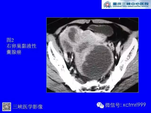 【病例】卵巢粘液性囊腺癌1例CT影像表现
