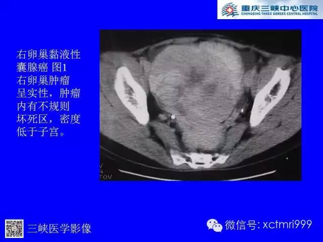 【病例】卵巢粘液性囊腺癌1例CT影像表现