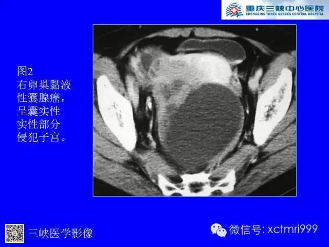 【病例】卵巢粘液性囊腺癌1例CT影像表现