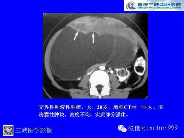 【病例】卵巢粘液性囊腺癌1例CT影像表现