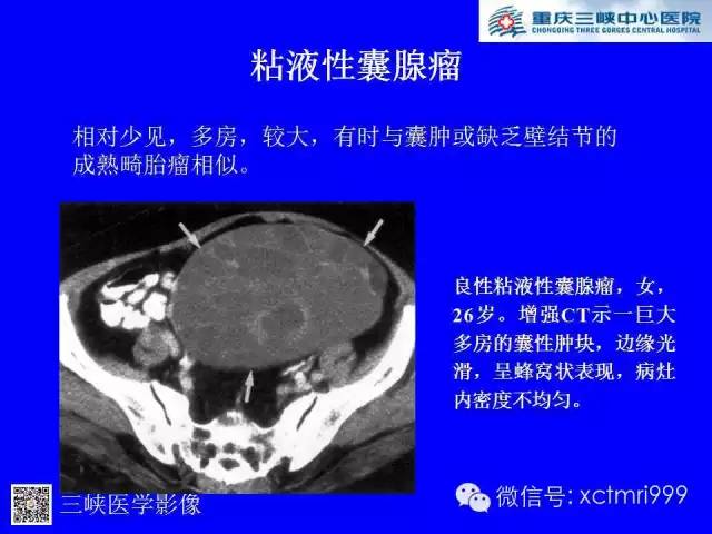 【病例】卵巢粘液性囊腺癌1例CT影像表现