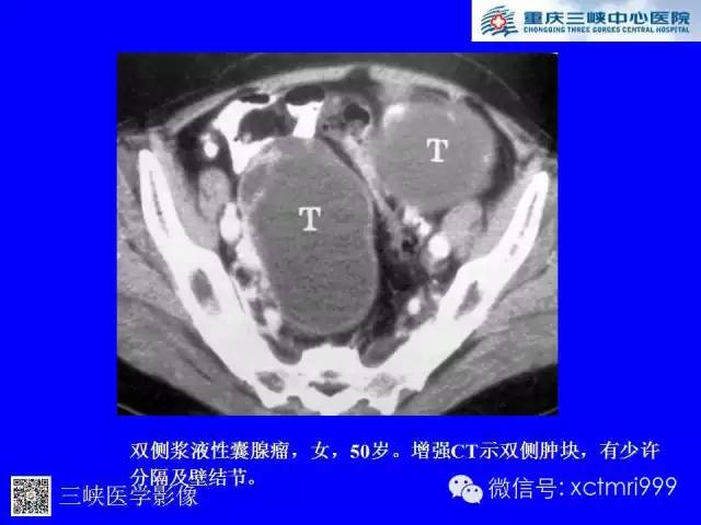 【病例】卵巢粘液性囊腺癌1例CT影像表现