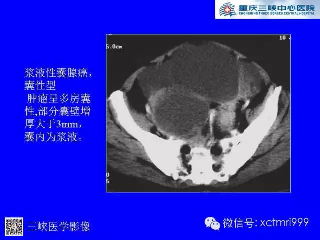 【病例】卵巢粘液性囊腺癌1例CT影像表现