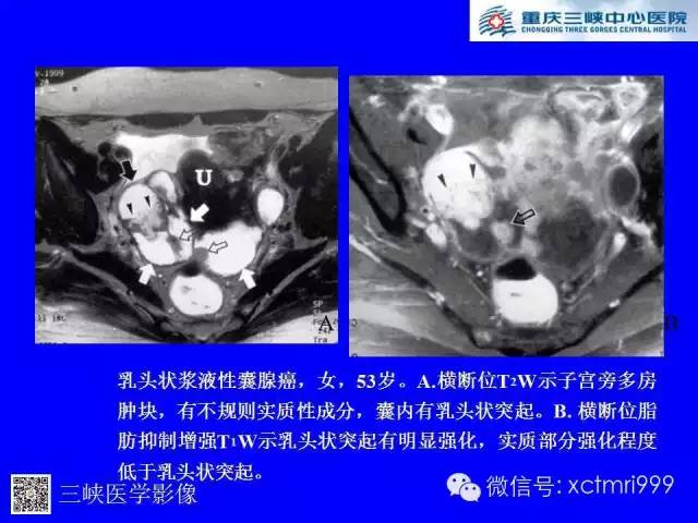 【病例】卵巢粘液性囊腺癌1例CT影像表现