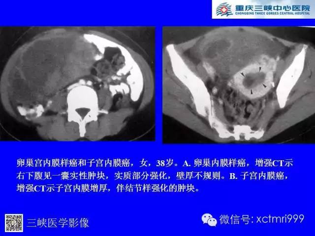 【病例】卵巢粘液性囊腺癌1例CT影像表现