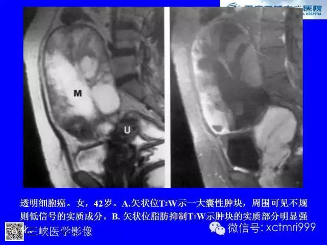 【病例】卵巢粘液性囊腺癌1例CT影像表现