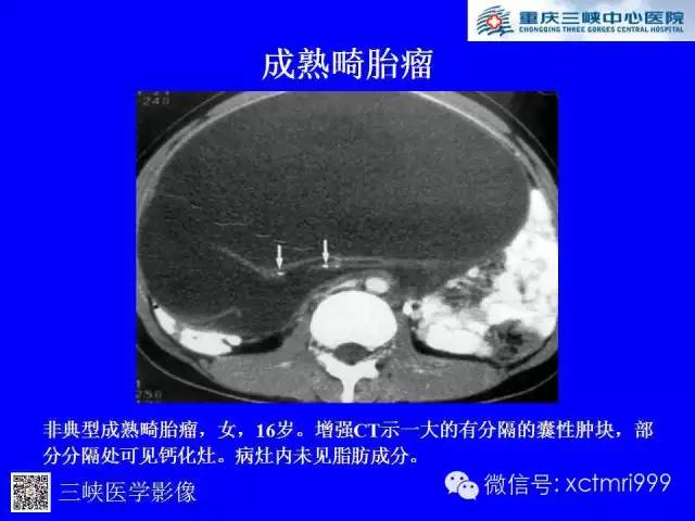 【病例】卵巢粘液性囊腺癌1例CT影像表现