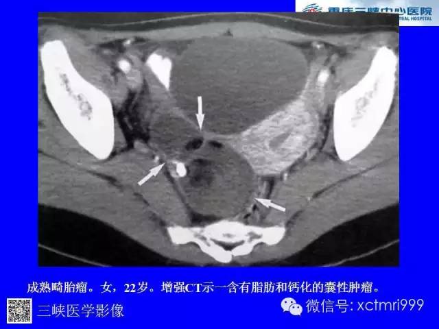 【病例】卵巢粘液性囊腺癌1例CT影像表现