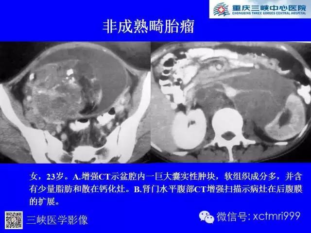 【病例】卵巢粘液性囊腺癌1例CT影像表现