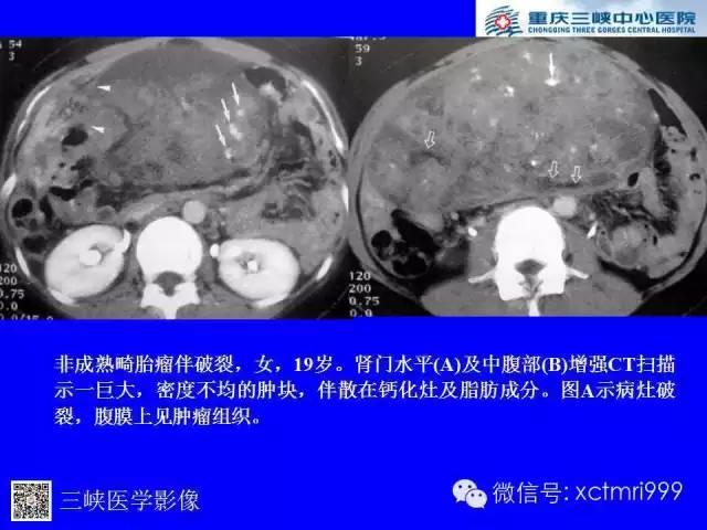 【病例】卵巢粘液性囊腺癌1例CT影像表现