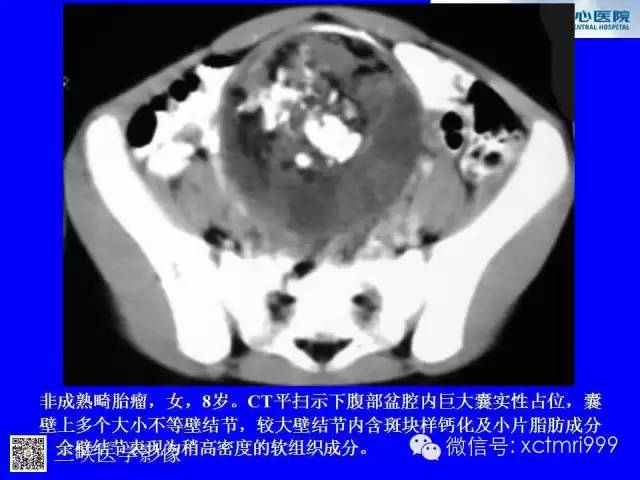 【病例】卵巢粘液性囊腺癌1例CT影像表现