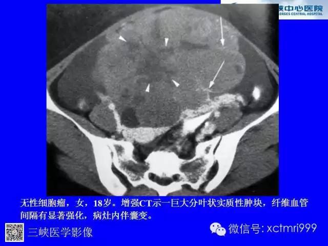 【病例】卵巢粘液性囊腺癌1例CT影像表现