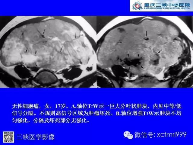 【病例】卵巢粘液性囊腺癌1例CT影像表现