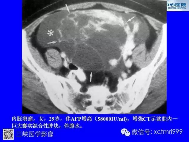 【病例】卵巢粘液性囊腺癌1例CT影像表现