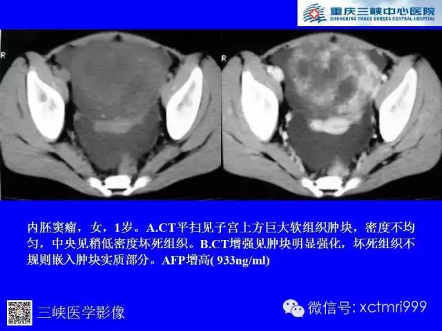 【病例】卵巢粘液性囊腺癌1例CT影像表现