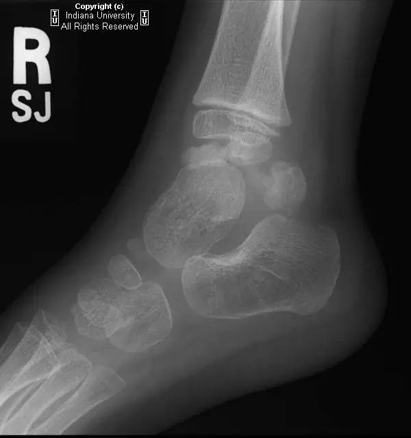【病例】胫骨远侧骨骺Trevor's病1例X线CT影像表现 【病例】胫骨远侧骨骺Trevor's病1例X线CT影像表现