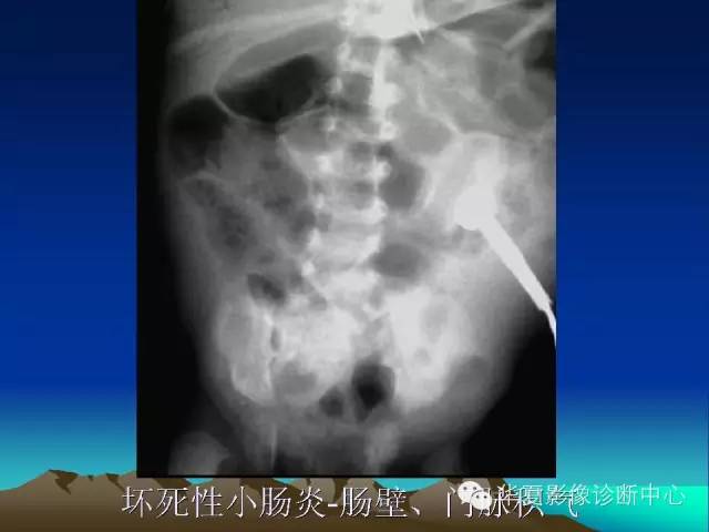 胆管积气和门脉积气的鉴别