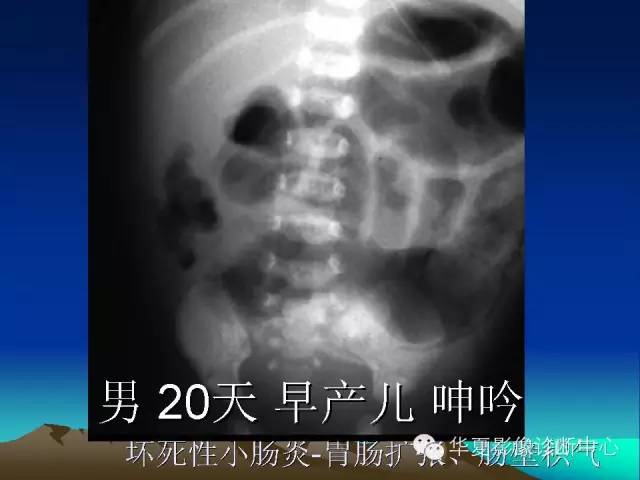 胆管积气和门脉积气的鉴别