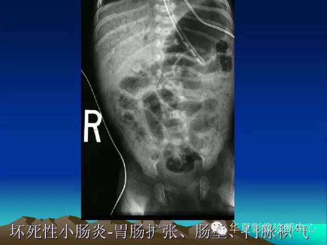 胆管积气和门脉积气的鉴别