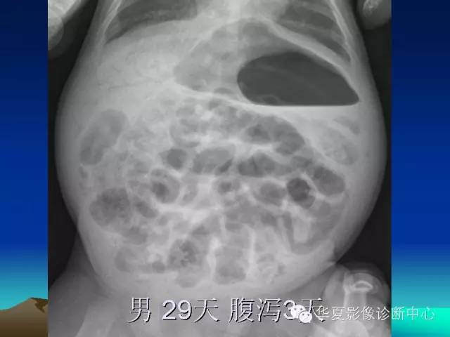 胆管积气和门脉积气的鉴别