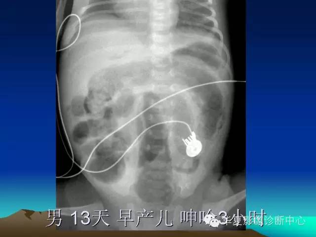 胆管积气和门脉积气的鉴别