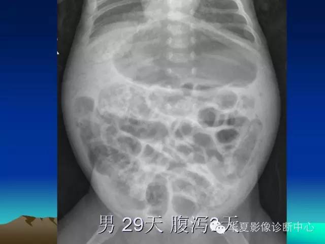 胆管积气和门脉积气的鉴别