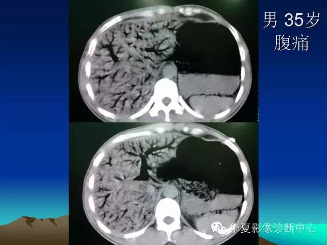 胆管积气和门脉积气的鉴别