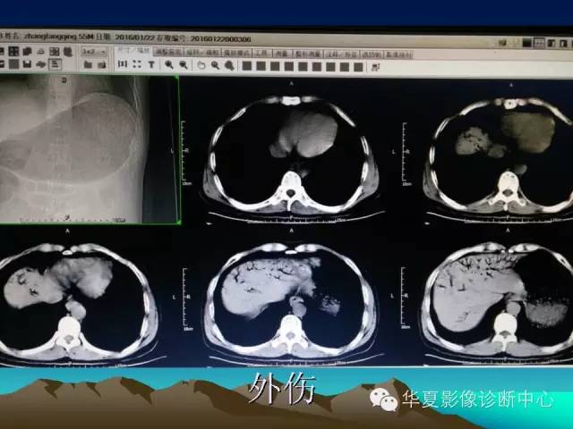 胆管积气和门脉积气的鉴别
