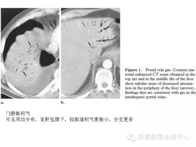 【PPT】门脉积气的CT表现和鉴别