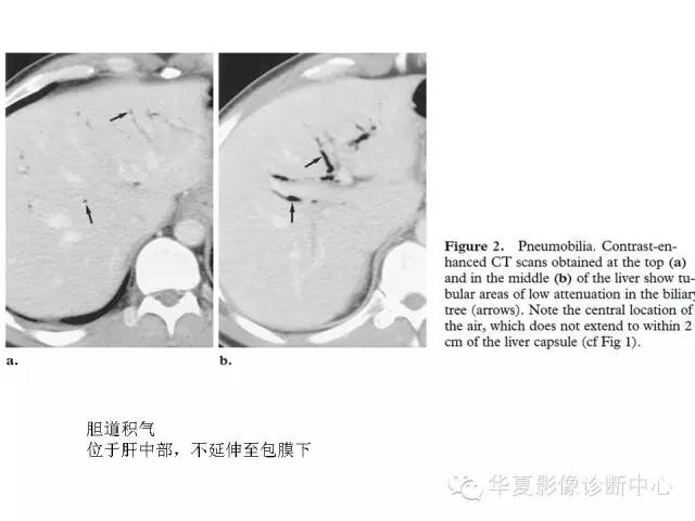 【PPT】门脉积气的CT表现和鉴别